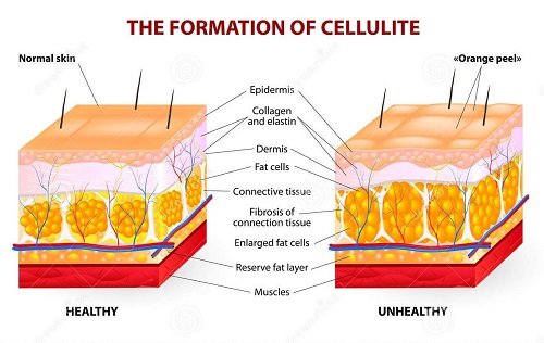 formation-cellulite-vector-diagram-occurs-most-females-rarely-males-34935527